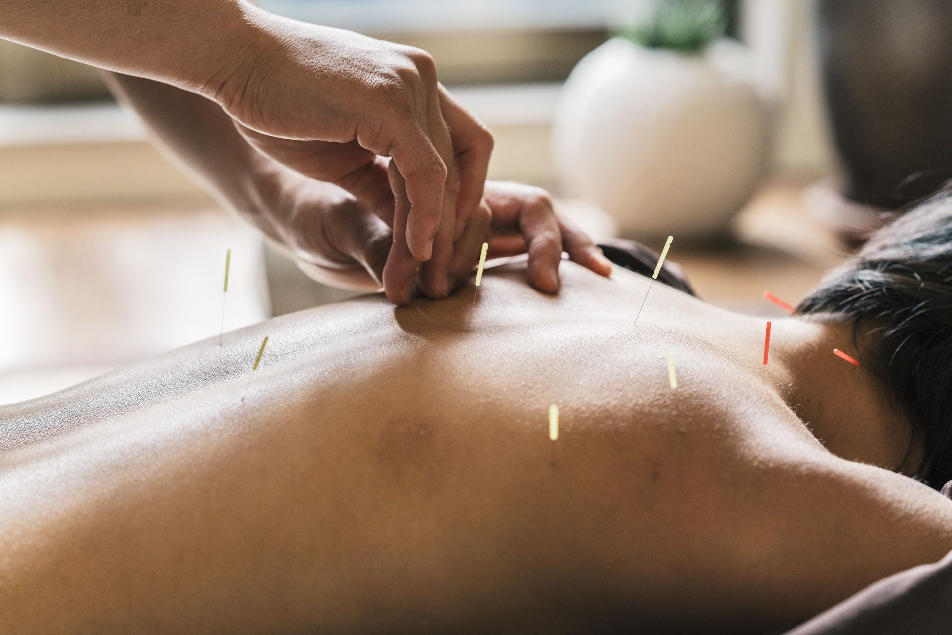 A person is getting acupuncture on their back.