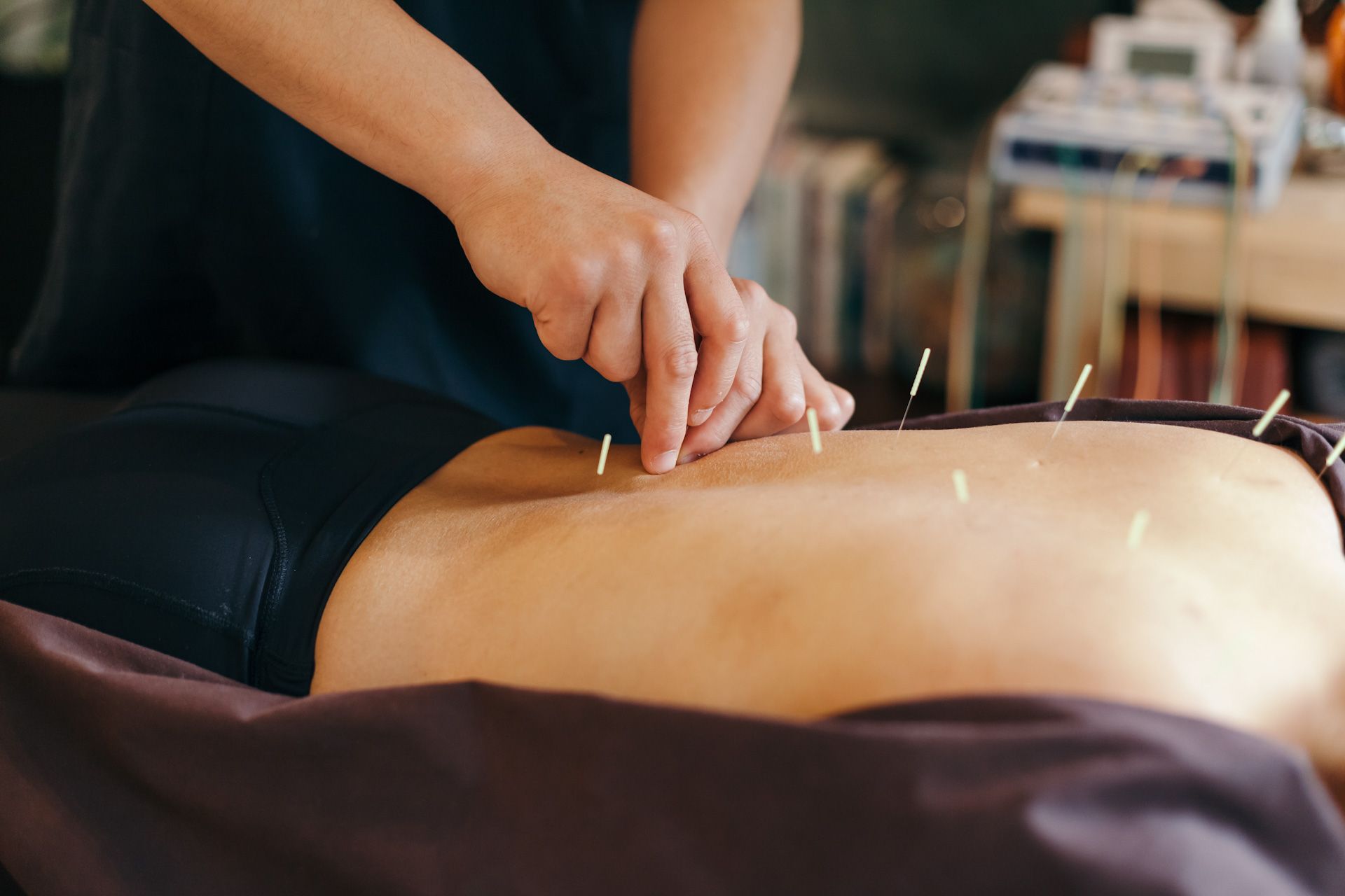 A person is getting acupuncture on their back.