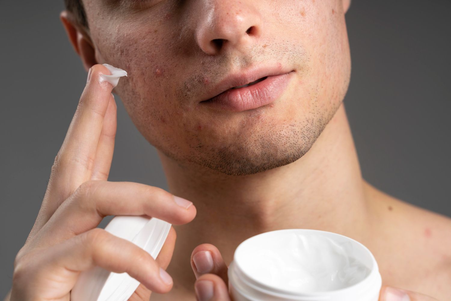 Man applying cream to his face, focusing on acne, with a white jar in hand.