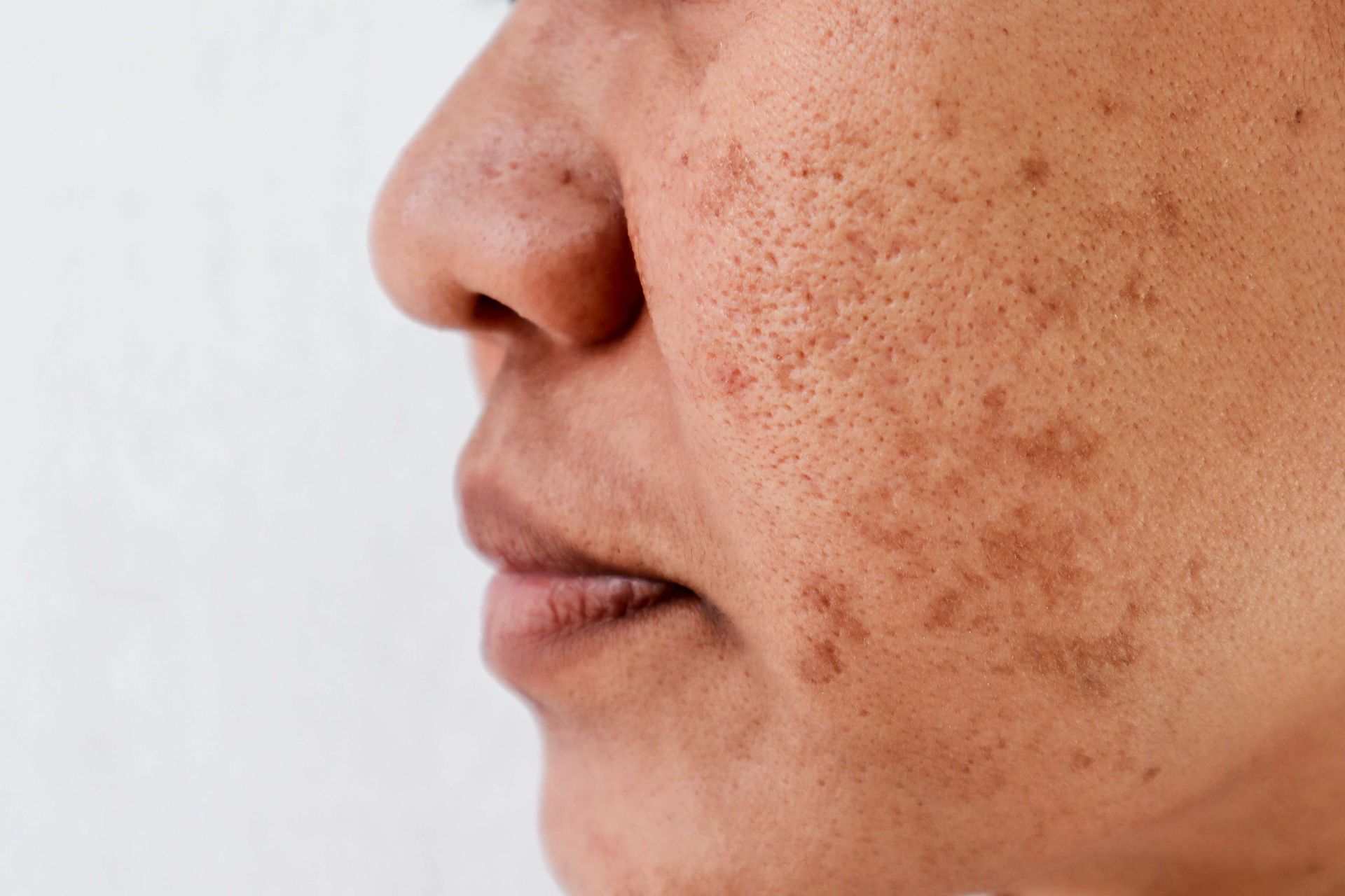 Close-up of a person's face showing skin with acne scars and dark spots.