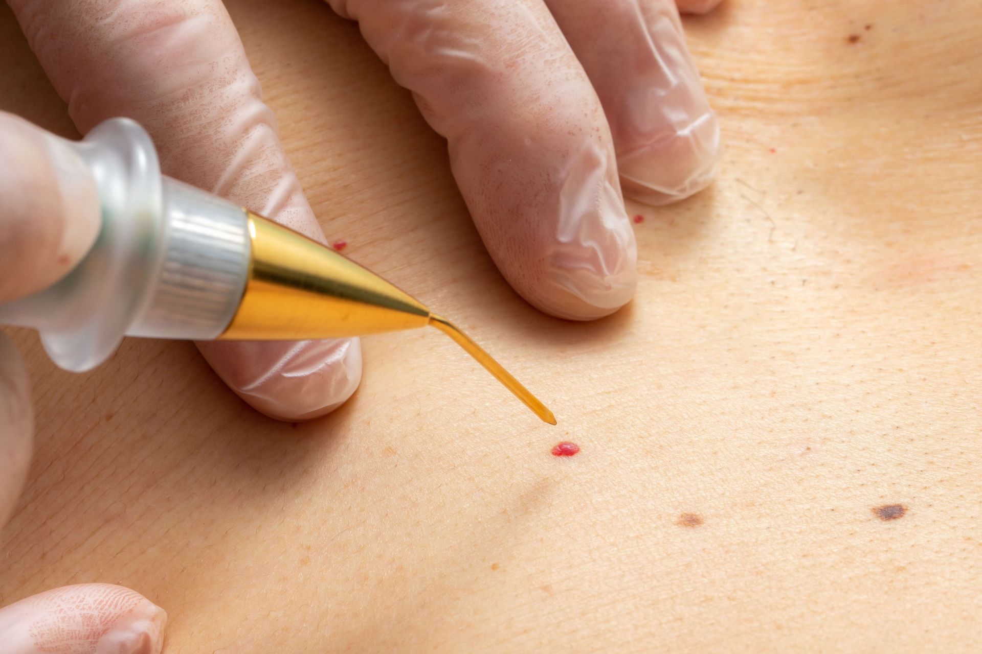 A gloved hand uses a laser tool to remove a mole from a person's skin.