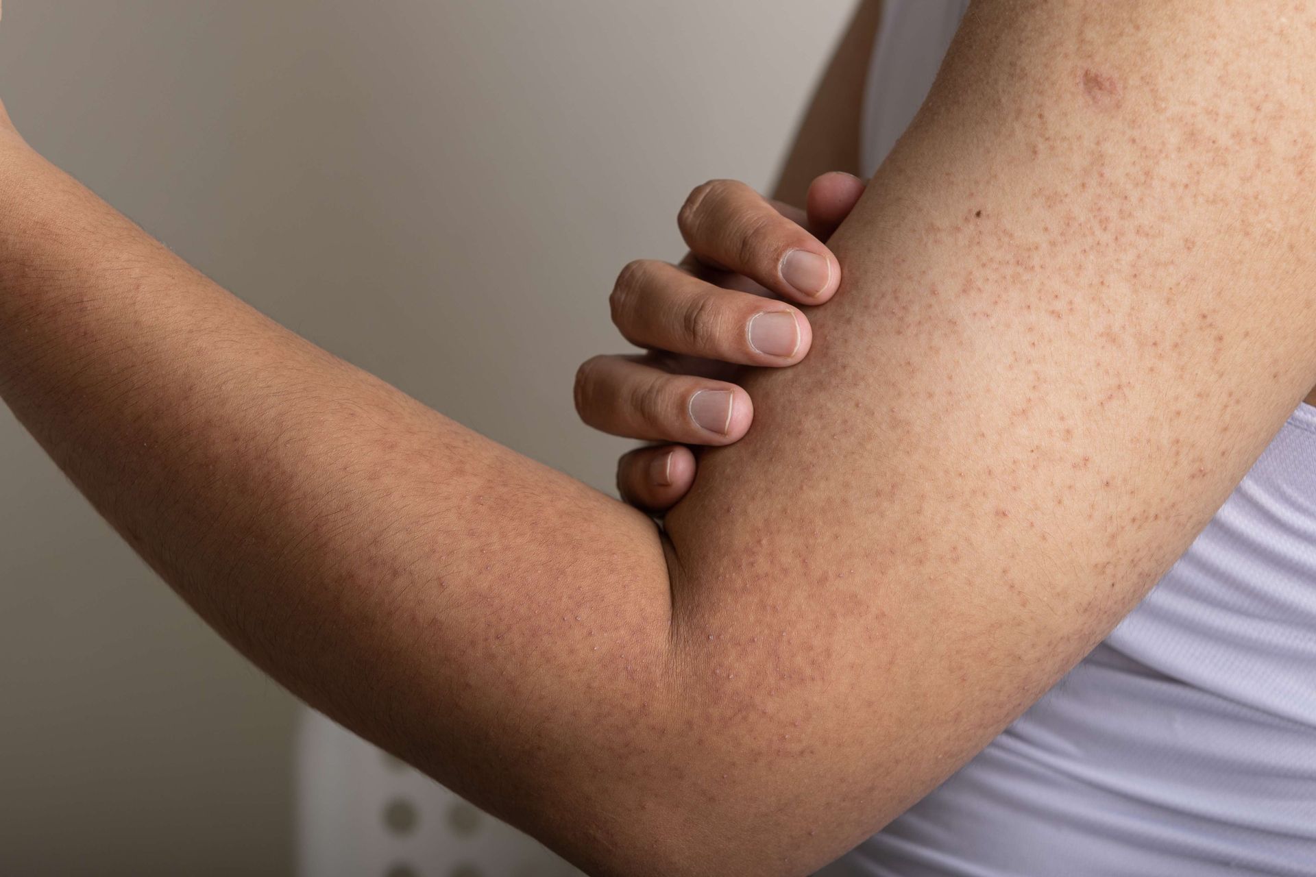 Person's arm with dry, bumpy skin. Hand is touching upper arm near elbow.