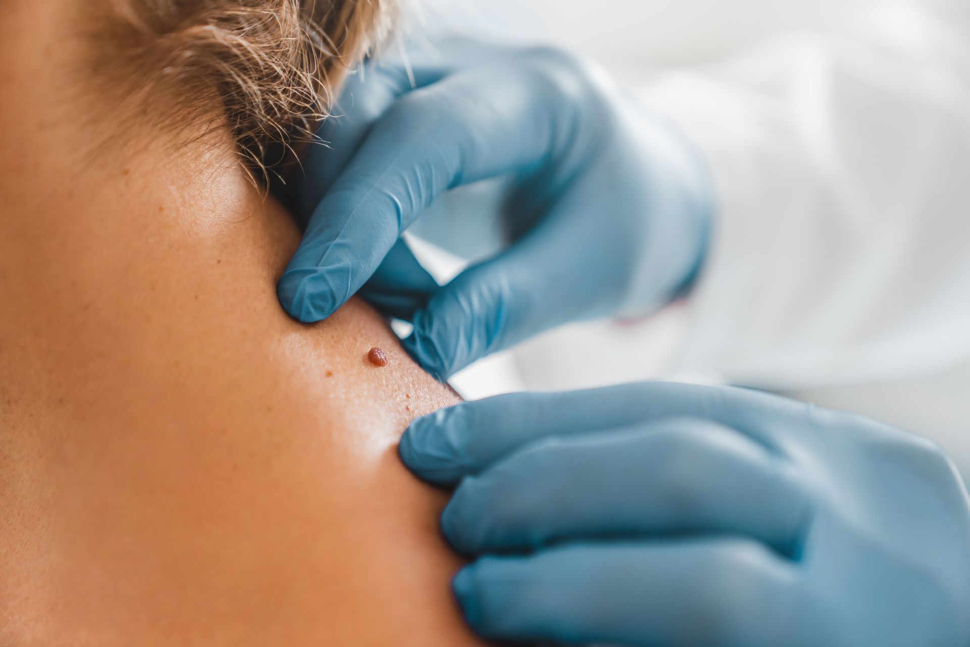A doctor is examining a mole on a woman 's back.