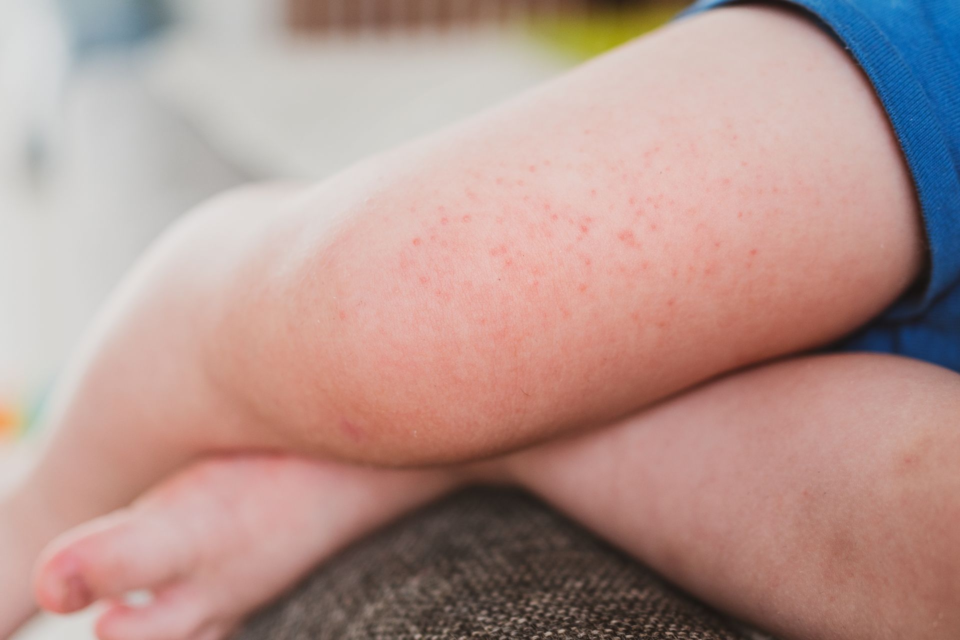 A close up of a child 's leg with red spots on it.