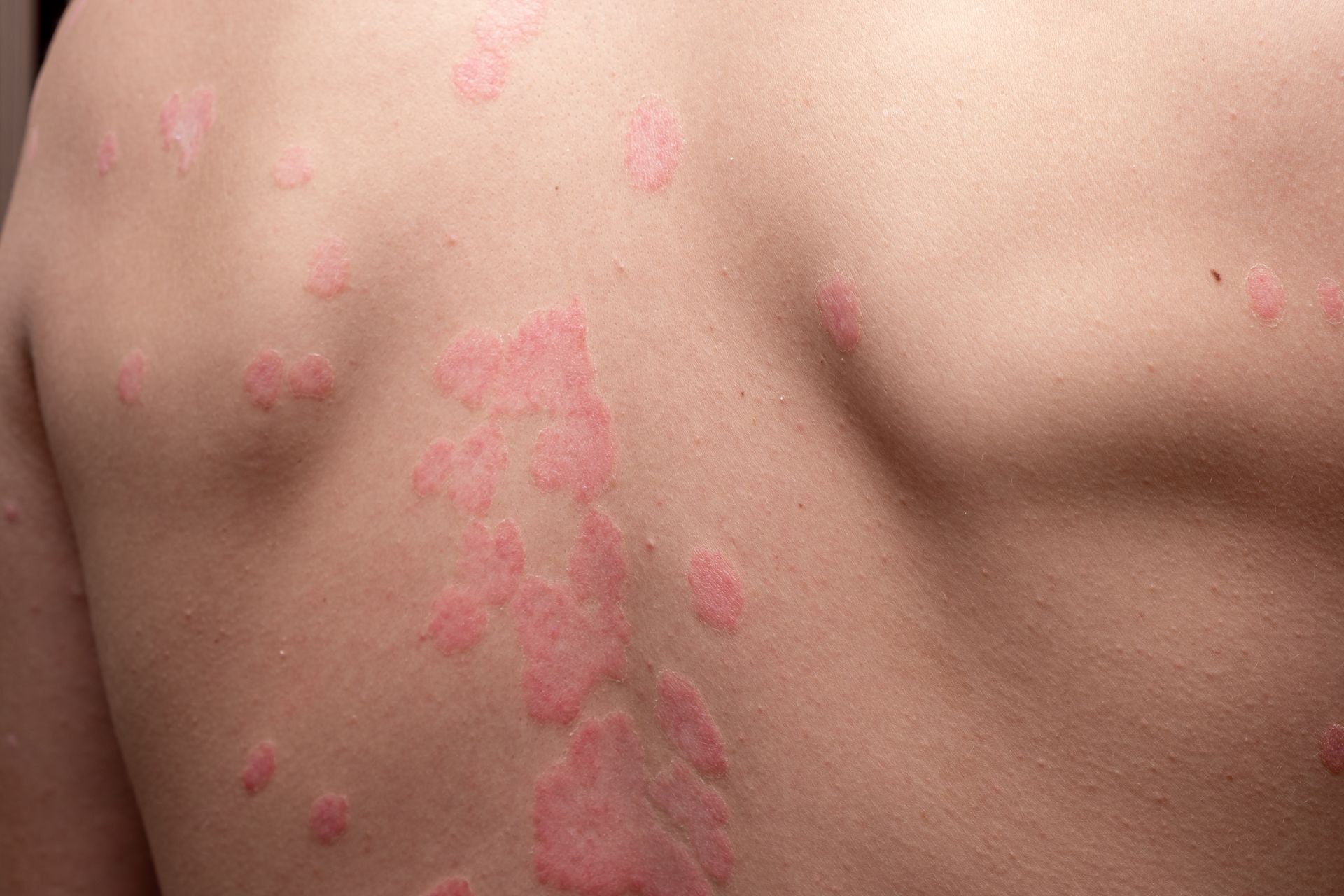 A close up of a person 's back with red spots on it.