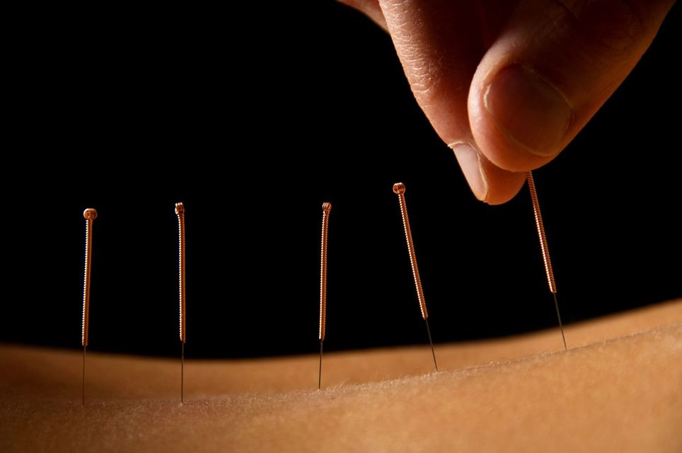 Una mano coloca agujas de acupuntura en la piel sobre un fondo oscuro
