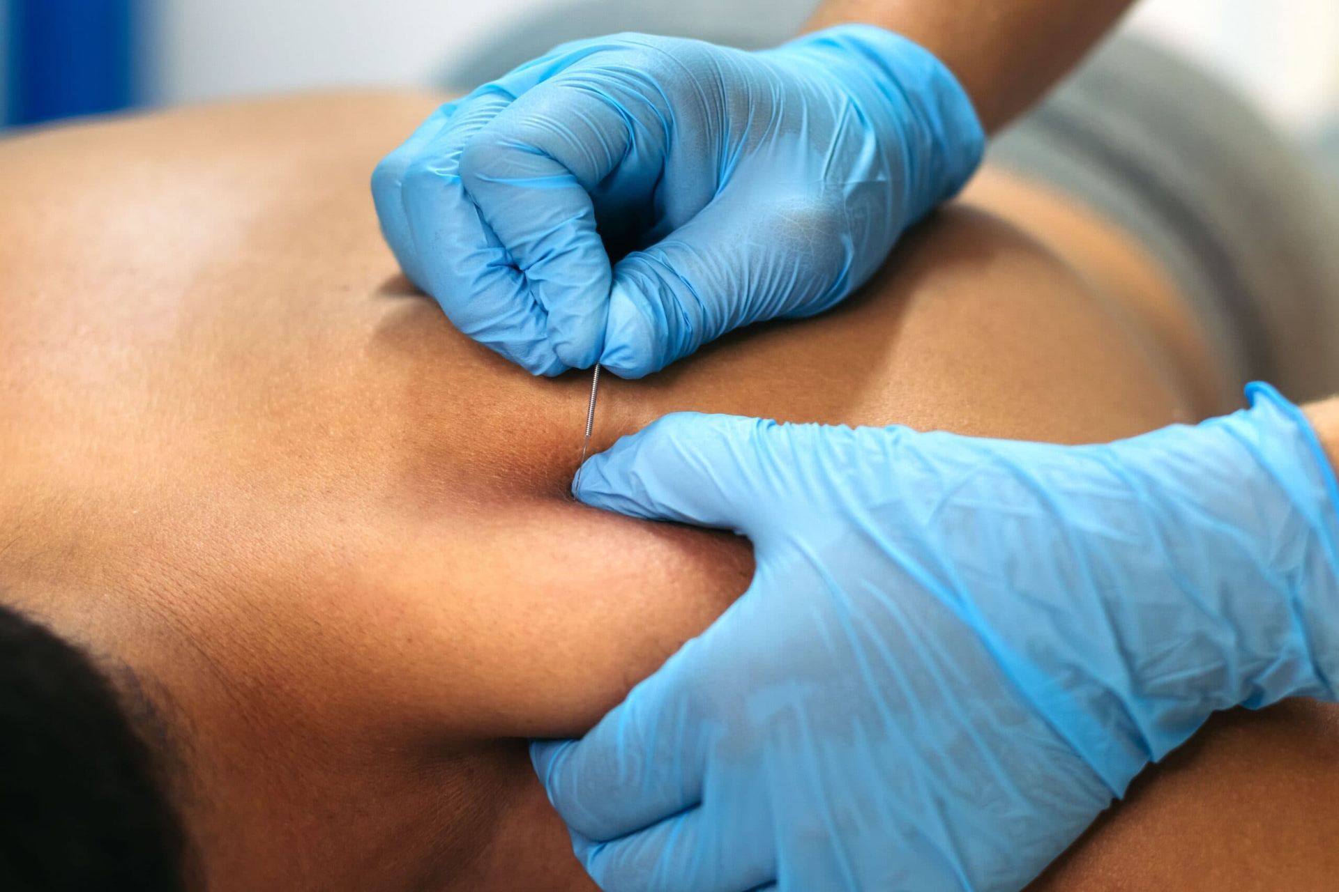 Hands inserting acupuncture needles into a person's back. Hands inserting acupuncture needles into a person's back.
