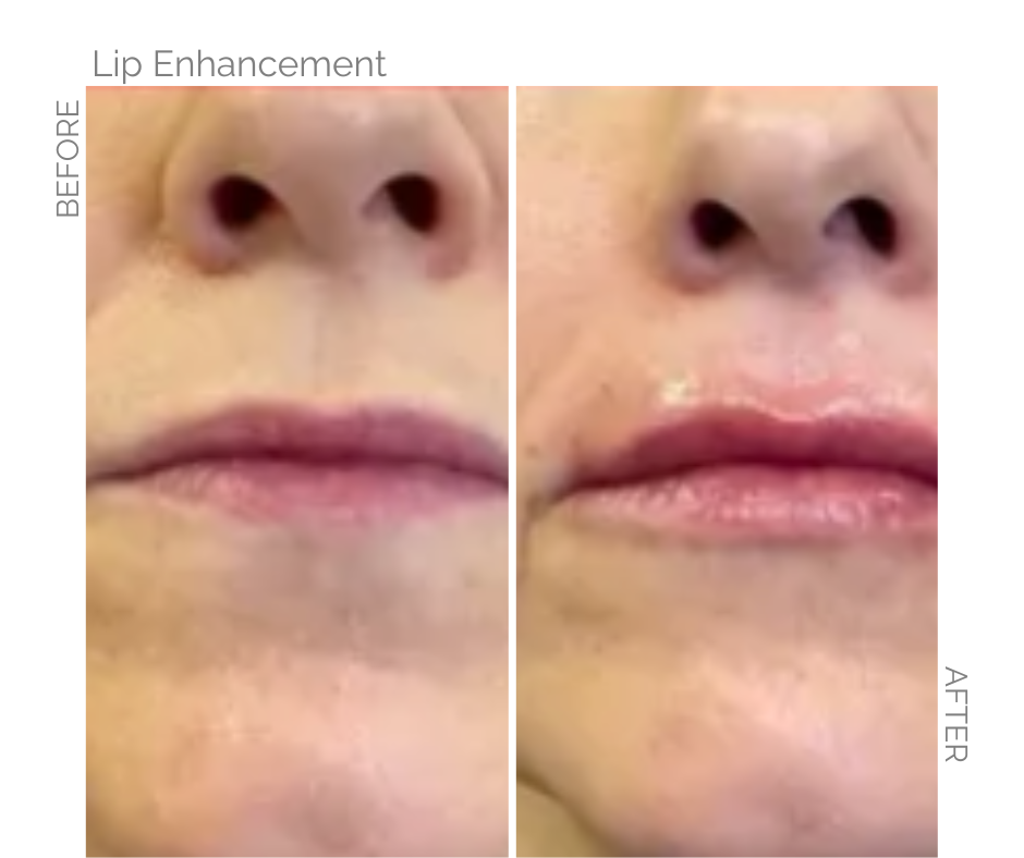 Subtle Lip enhancement on Norfolk lady