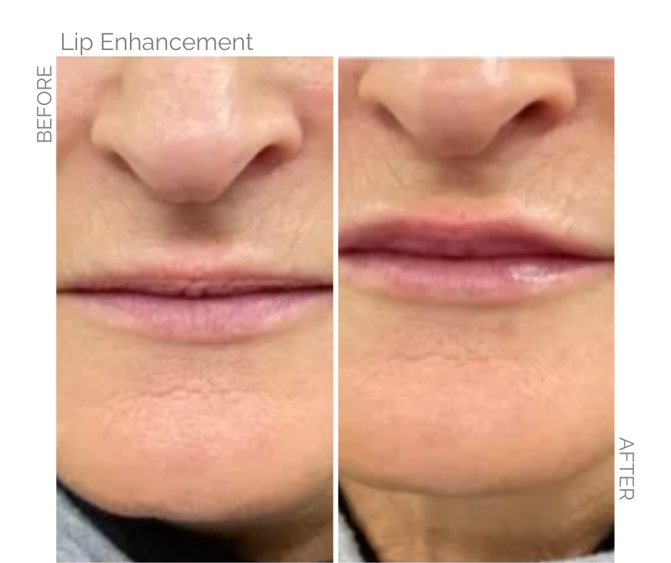 Lip enhancement performed on lady in Norwich Before and after images