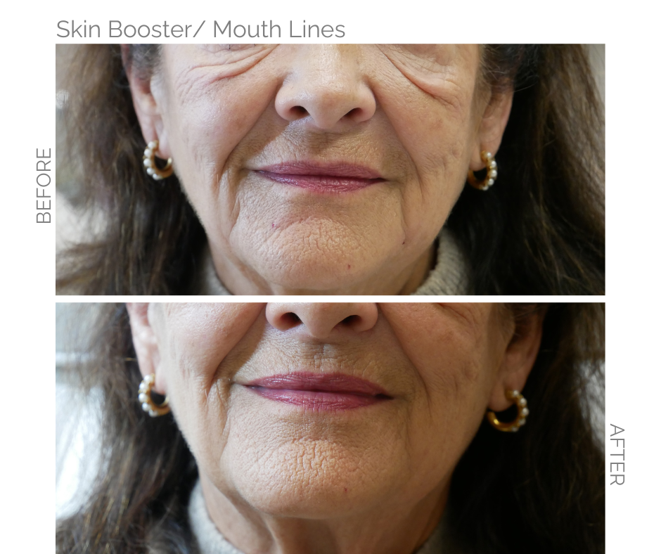 Skin booster used to smooth mouth lines