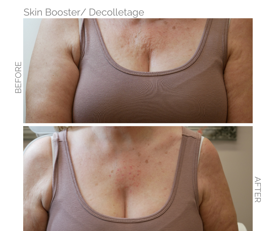 Skin booster used to smooth the lines on the chest area