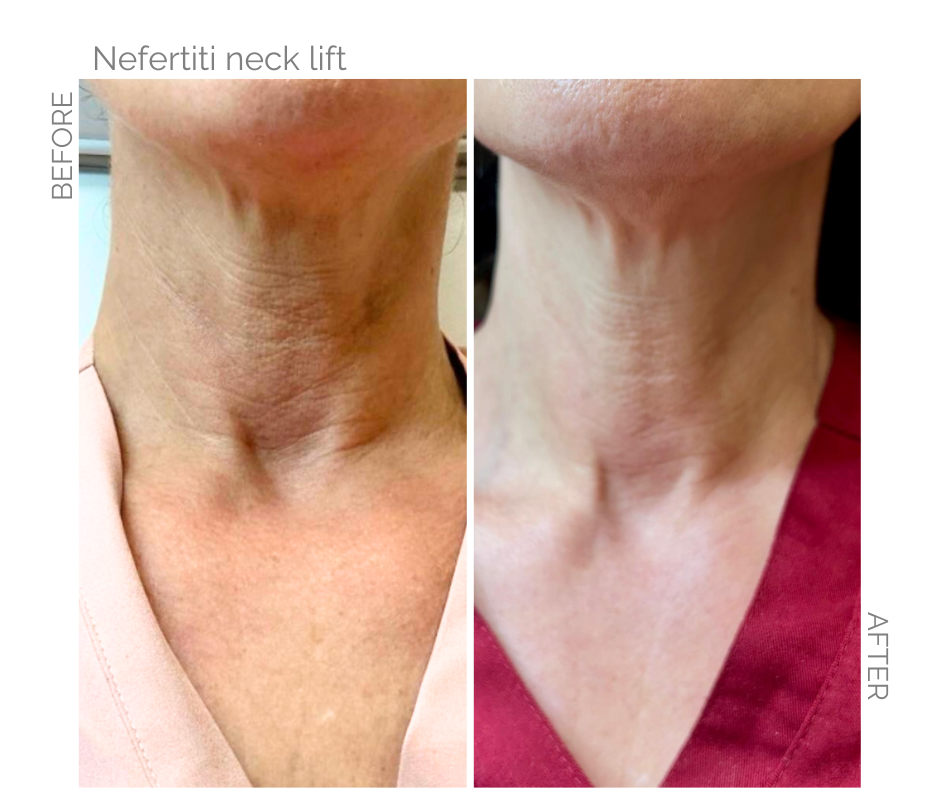 Neck lift done with anti wrinkle injections on lady in Norfolk before and after