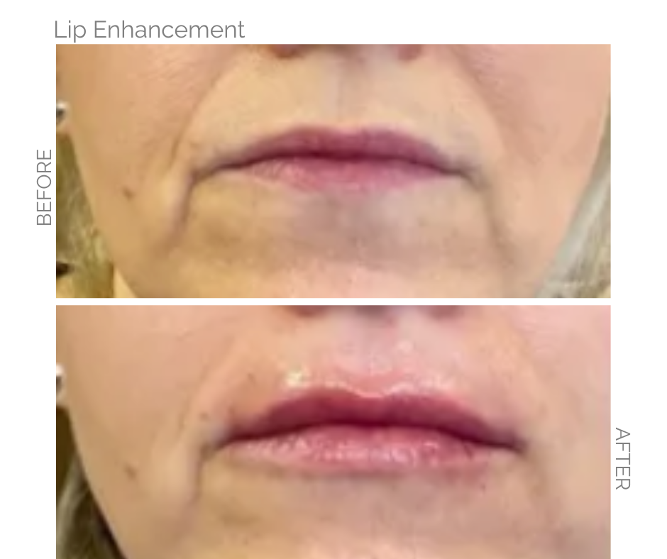 Fuller lips after lip enhancement performed in Norwich on a lady