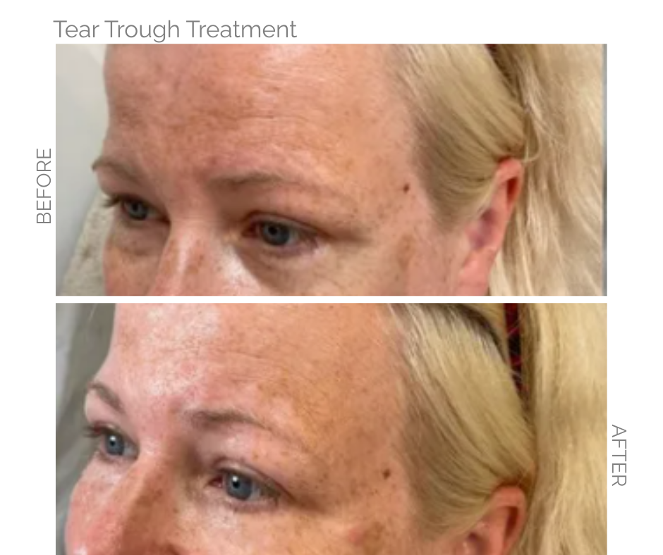 Before and after photos showing tear trough treatment results. Dark circles visibly reduced.