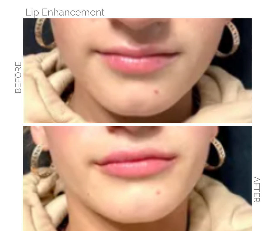 Comparison of lip enhancement results: Before and after injections, fuller lips.