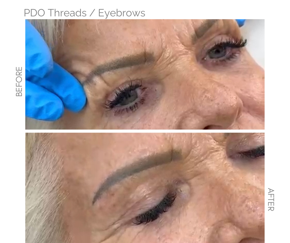 Eyebrow lift with PDO Threads