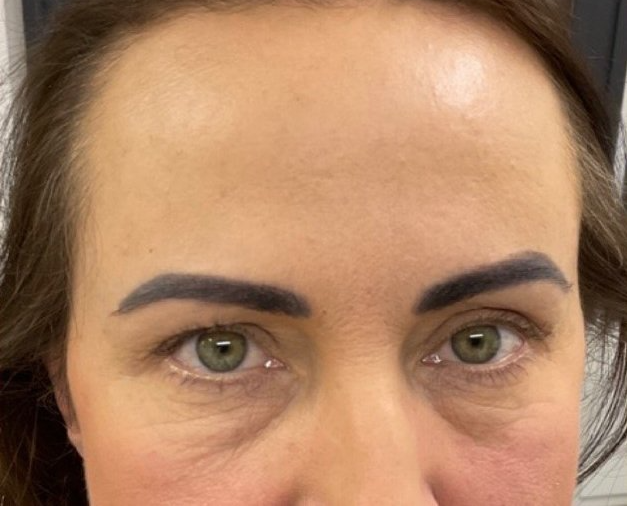 After having anti wrinkle injection