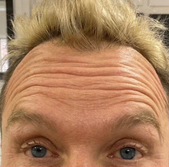 Norwich client before anti wrinkle injections 