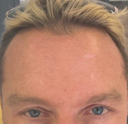 same Norwich client after having anti wrinkle injections