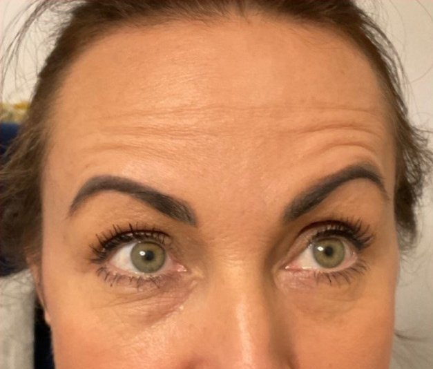 Wrinkles before anti wrinkle injection