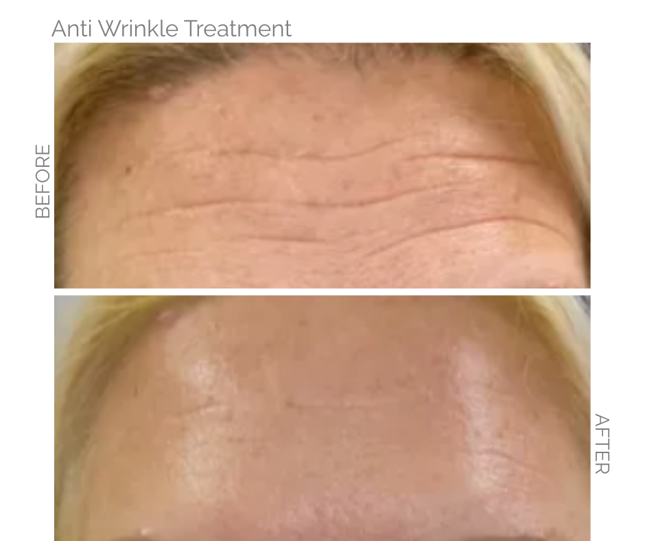 Comparison of woman's forehead before and after anti-wrinkle treatment; wrinkles smoothed out in