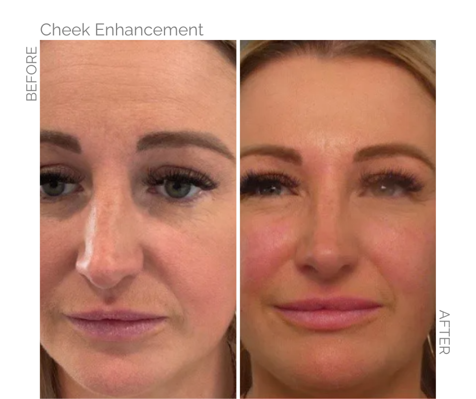 Side-by-side photos comparing a woman's face before and after cheek enhancement, showing plumper cheeks and smoother skin.
