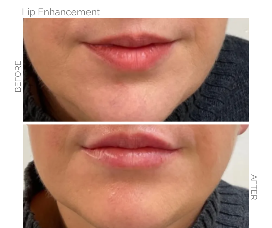 Before and after comparison of lip enhancement: upper lips are fuller after treatment.