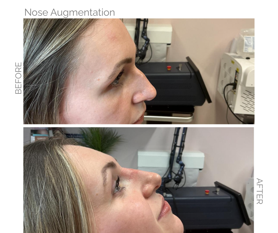 Before-and-after profile photos of a woman’s nose augmentation in a clinical setting