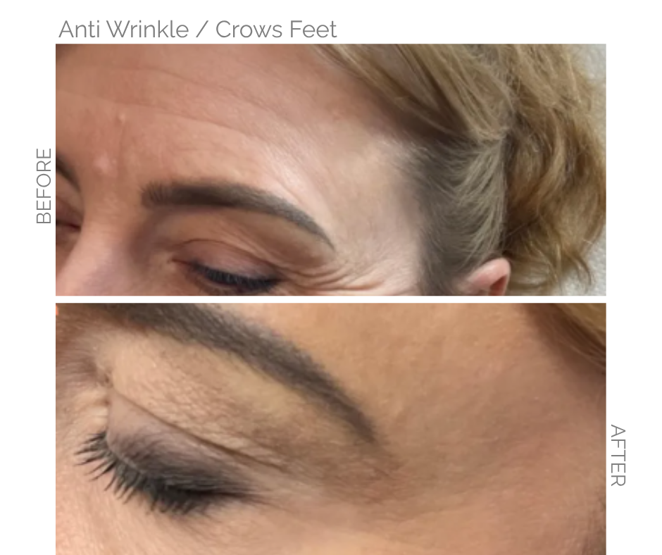 Anti Wrinkle Injections For Crows Feet on Lady in Norwich