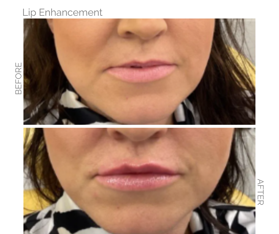 Enhanced top lip for Norwich lady using filler
