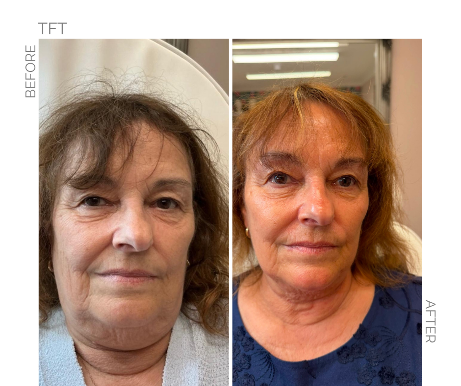 Total Face Transformation (TFT)