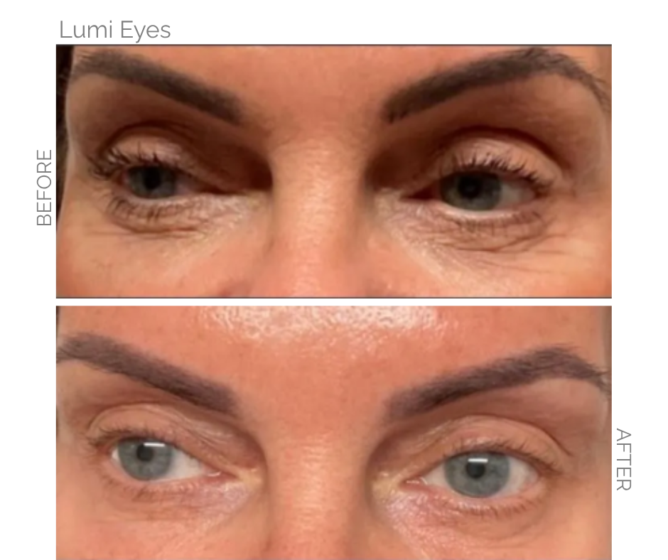 Before and after pictures of Lumi Eyes Treatment
