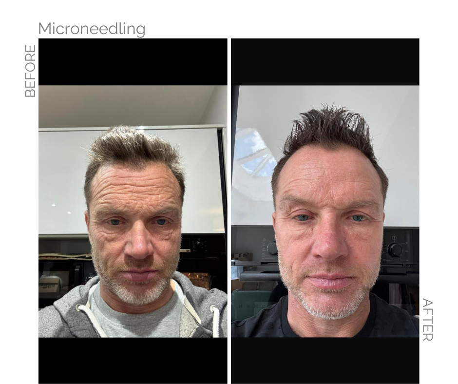 Before and after pictures of Microneedling treatments on a Norwich man