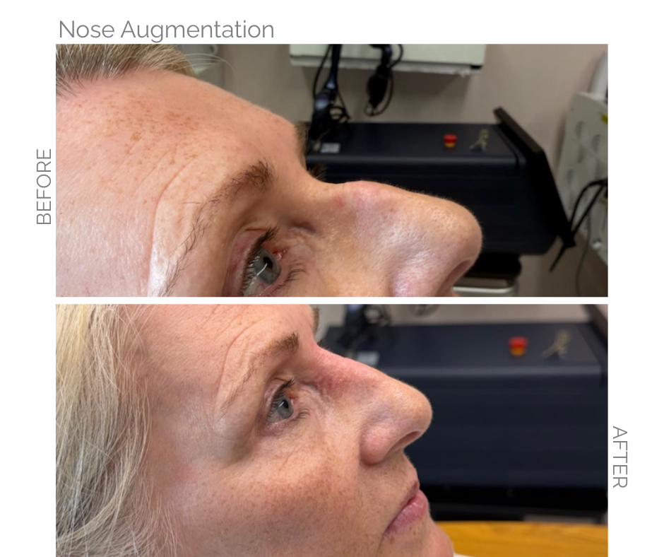 Before and after images of a nose augmentation