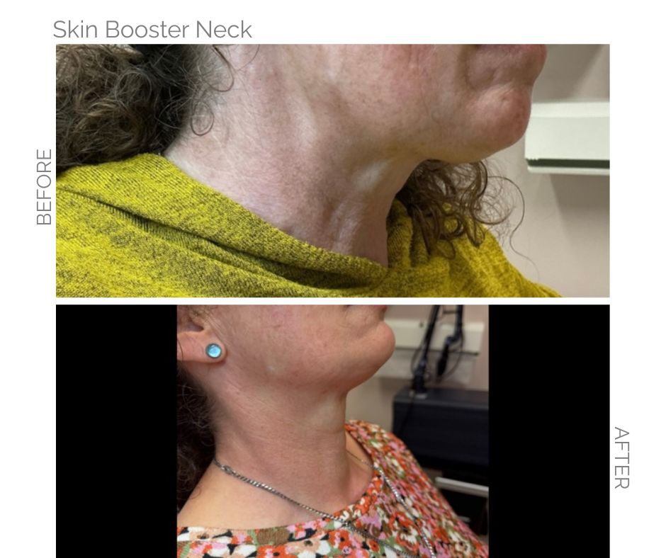 Before and After Images of skin booster treatment for the neck on lady in Norwich