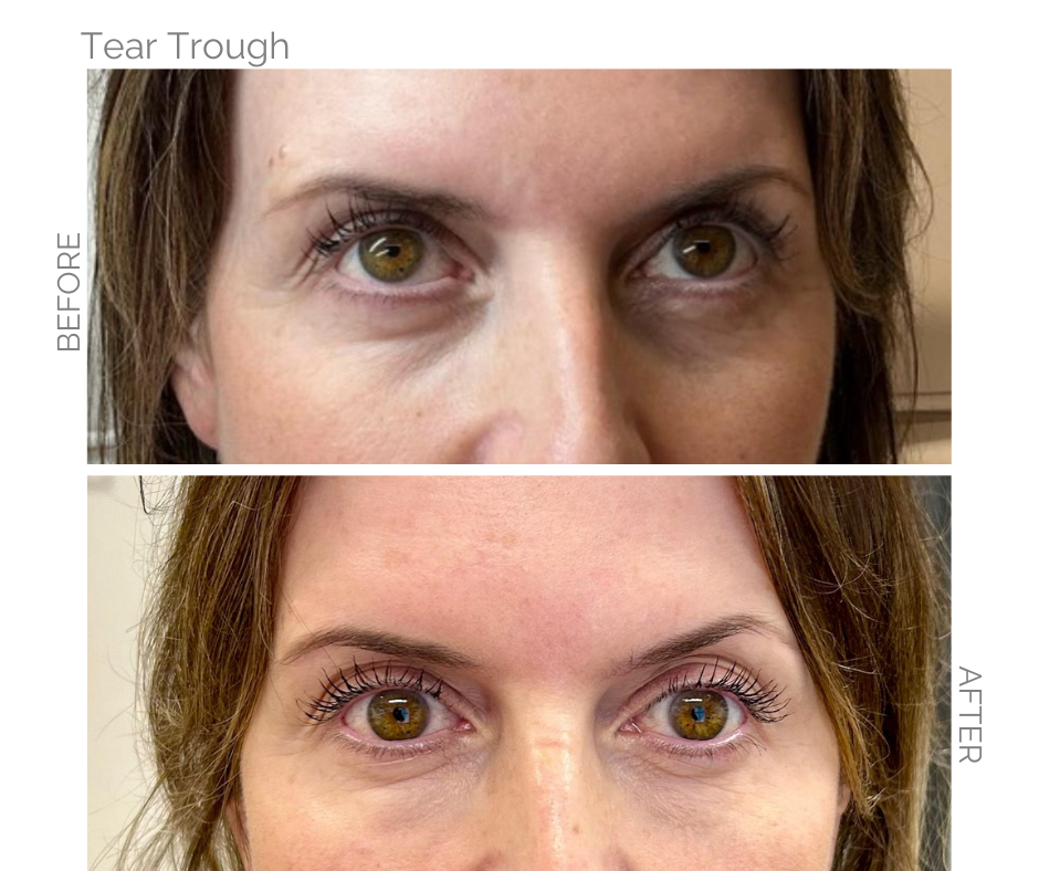 Tear Trough Treatment performed on this lady in Norwich