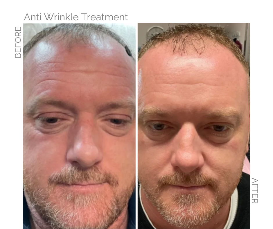 Before and after images of a man in Norwich who had anti wrinkle injections