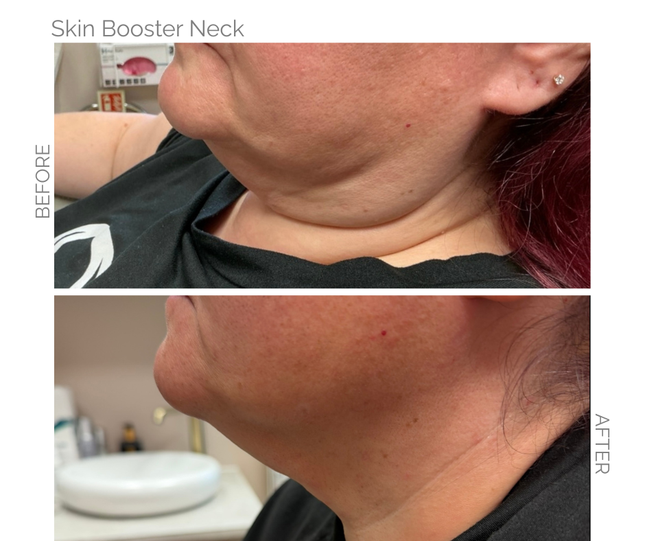 Before and after images of a skin booster treatment for the neck