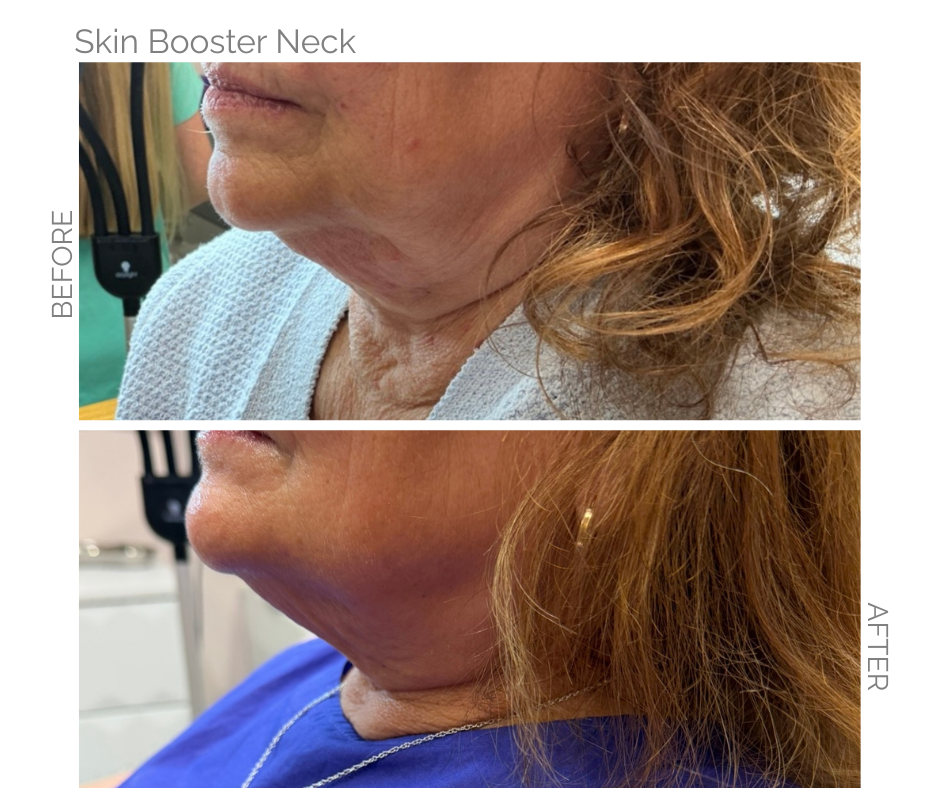 Neck pulled by gravity in image 1 and image 2 is after skin booster treatment