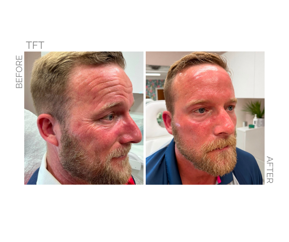 Total Face Transformation also known as TFT