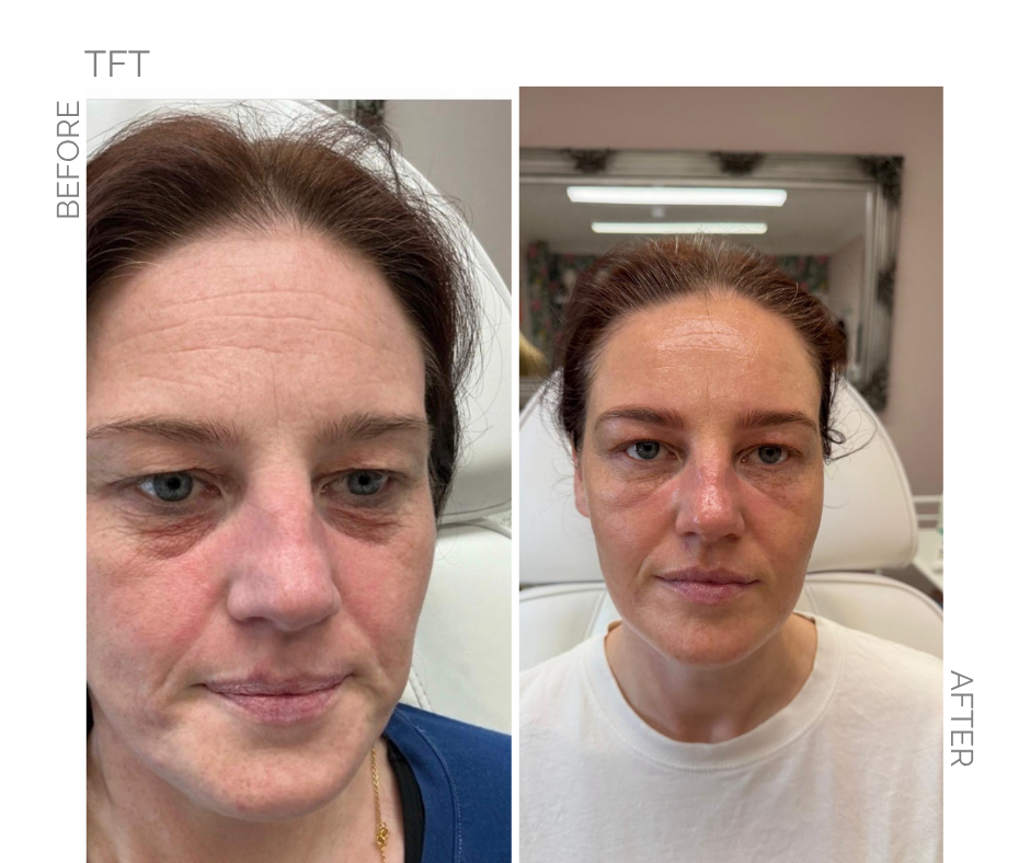 Total face Transformation on lady TFT