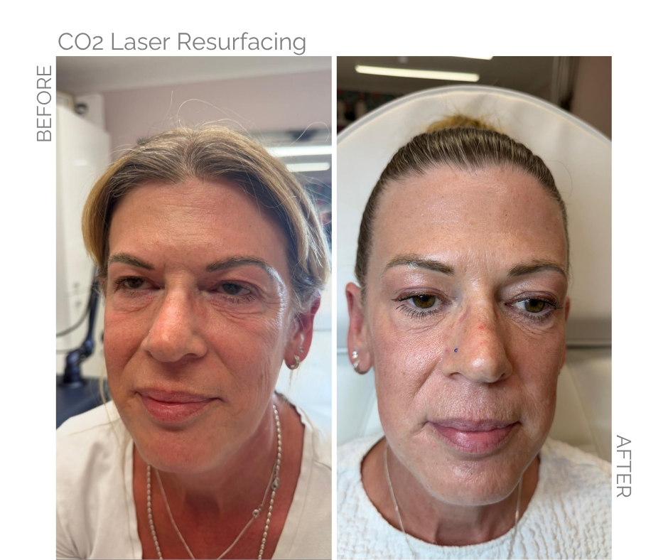 Lady who has had CO2 laser resurfacing before and after photos