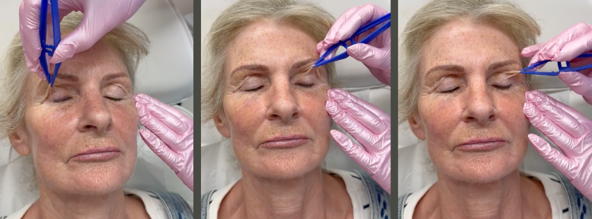 Hooded eyelids being pulled by tongs on a Norwich lady 