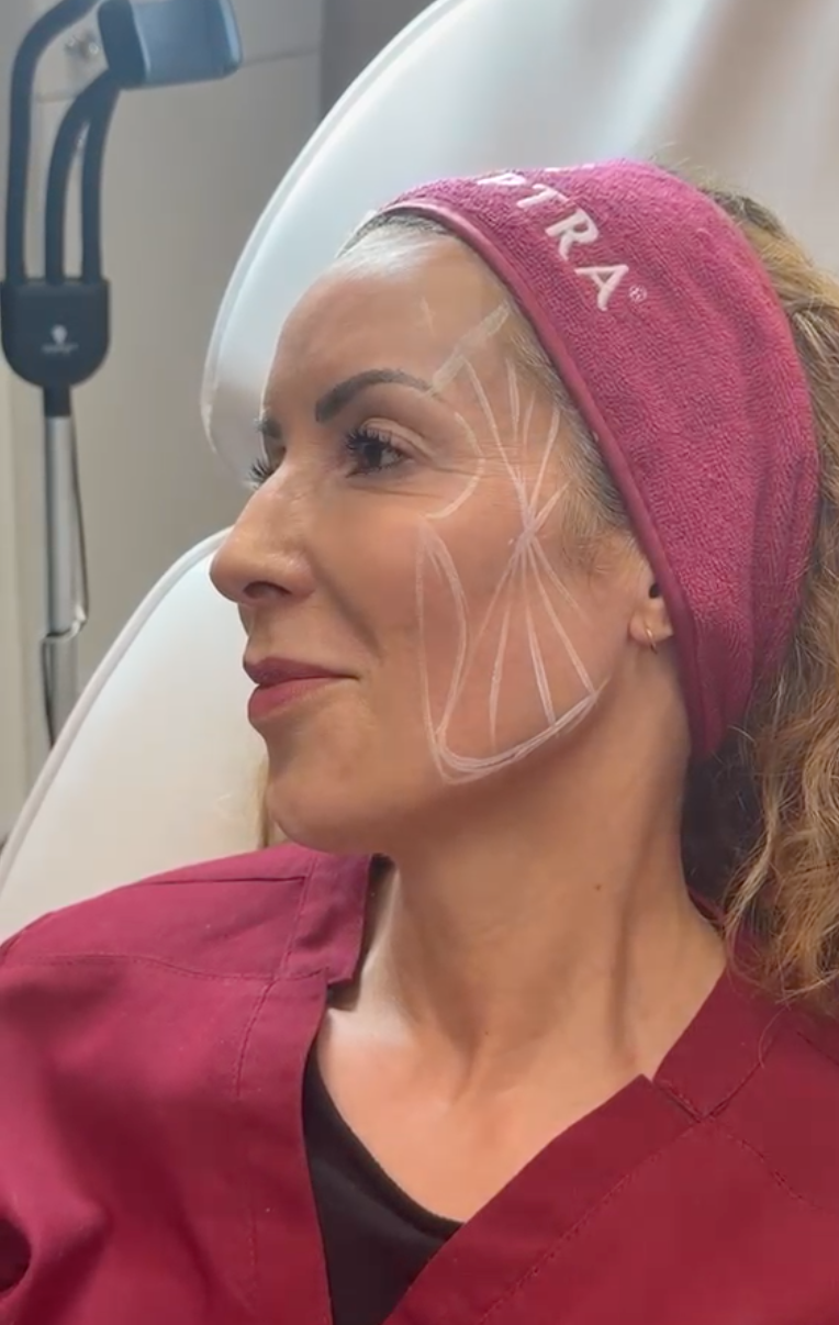 Lady getting face mapped for Sculptra by Galderma