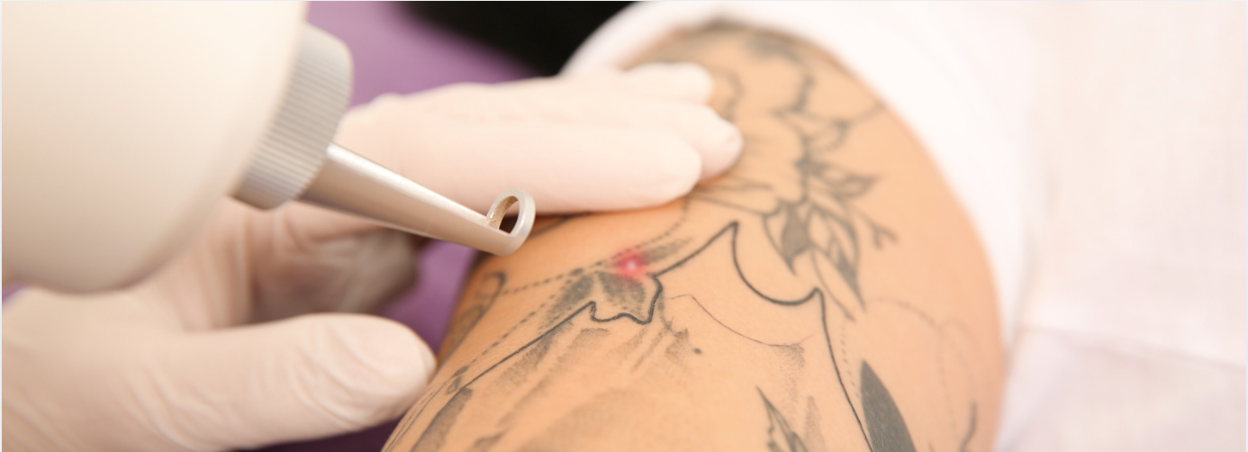 Laser Tattoo removal on a tattooed arm