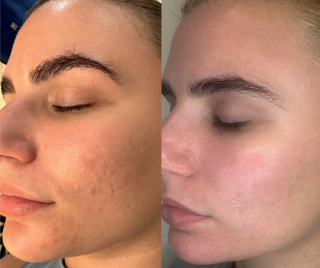 Microdermabrasion before and after treatment on face in Norwich clinic