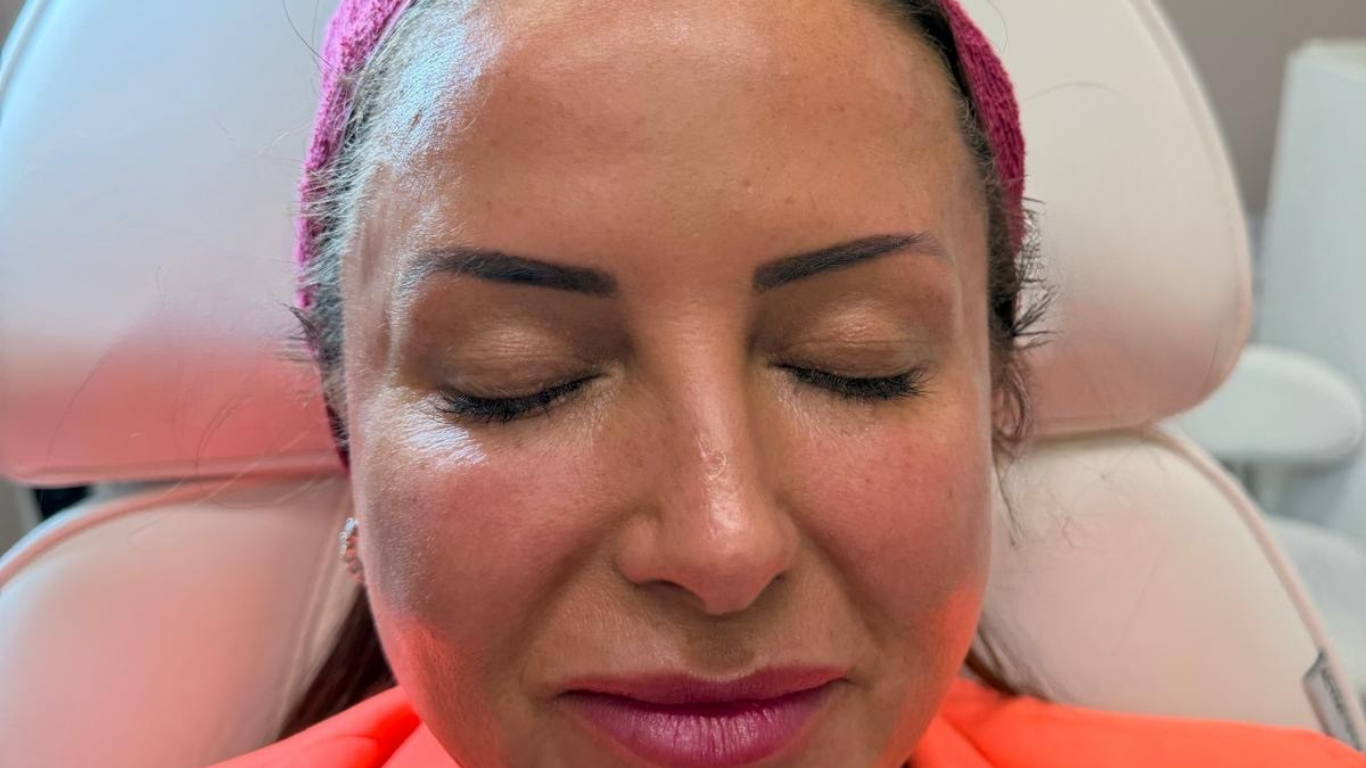 Lady after Sculptra treatment