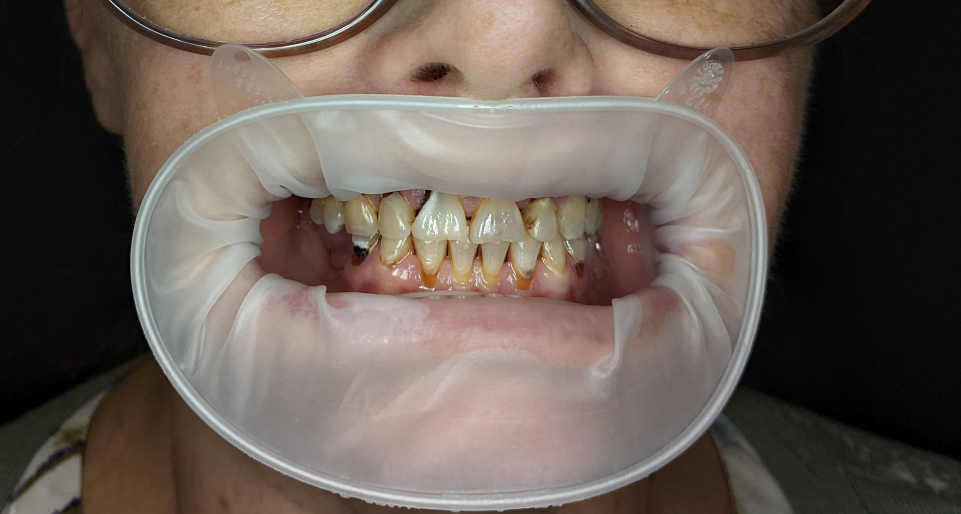 Dental Implant - Before Tooth