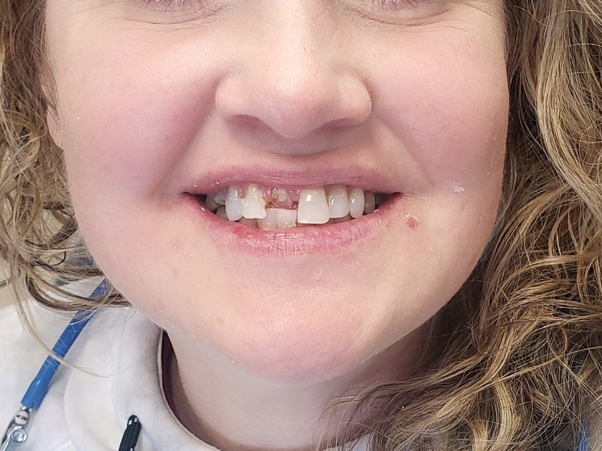 Dental Implant - Before Tooth