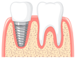 Root Canals, Crown & Bridges